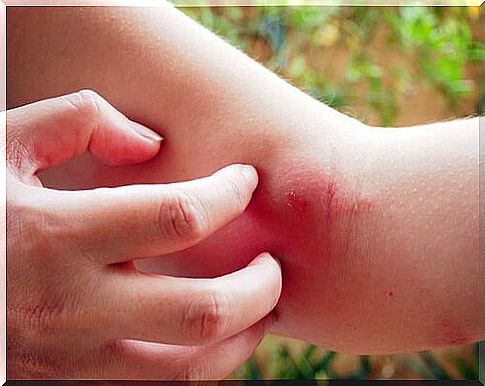 woman scratching herself insect bite